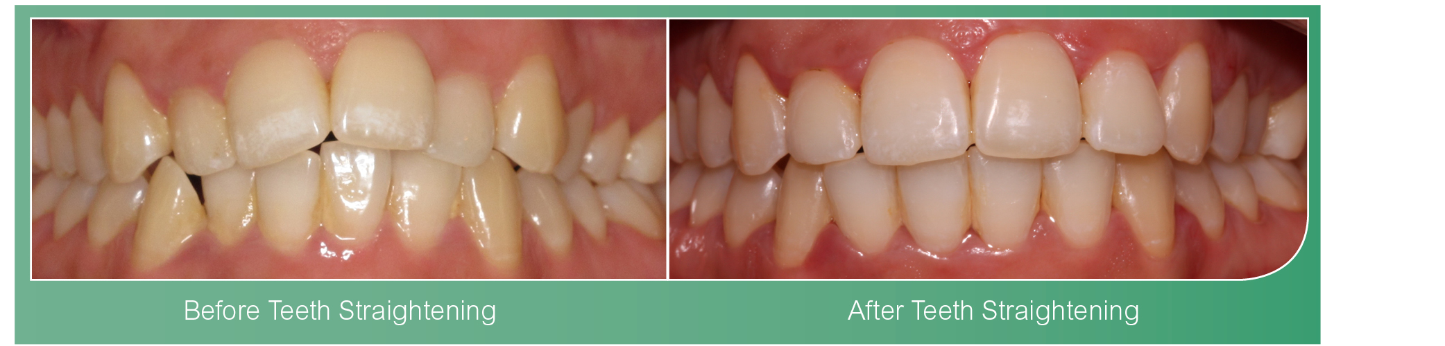 Clear Aligners Coventry