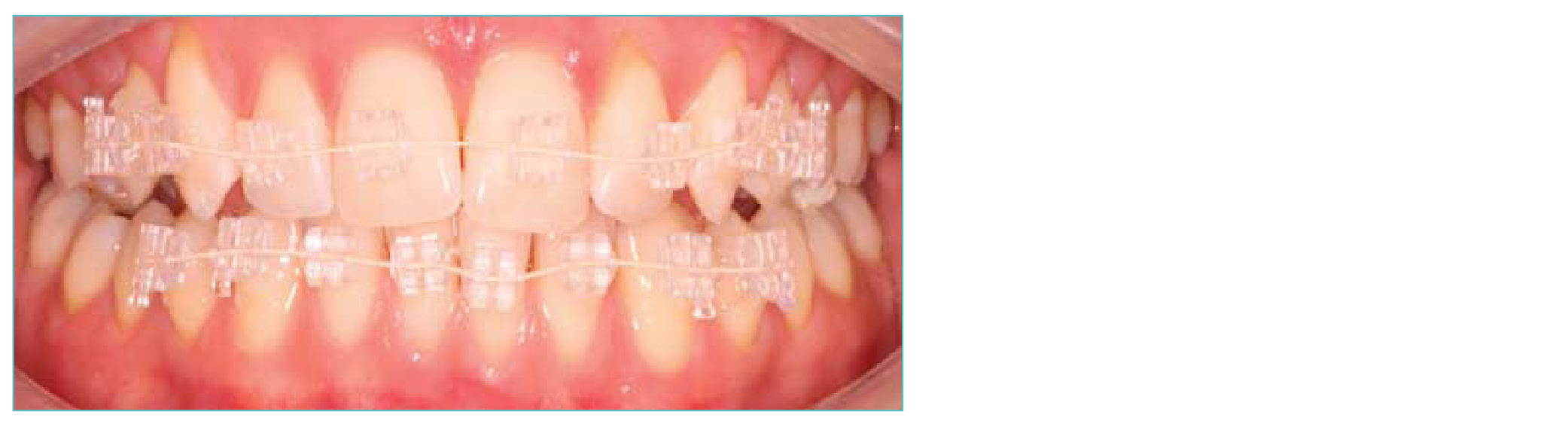 Quick Teeth Straightening Coventry