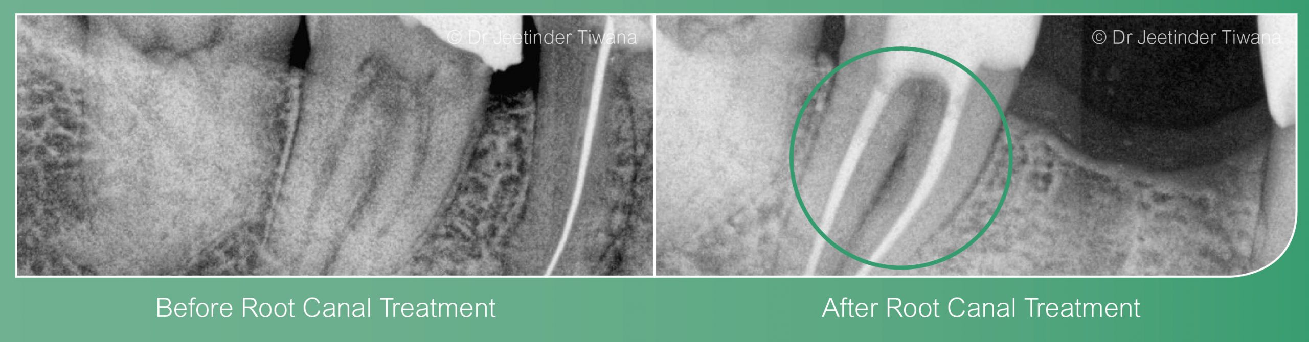 Root Canal Treatment Coventry