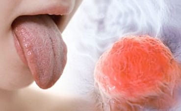 Tongue Cancer Warning – the Symptoms you Shouldn’t be Ignoring