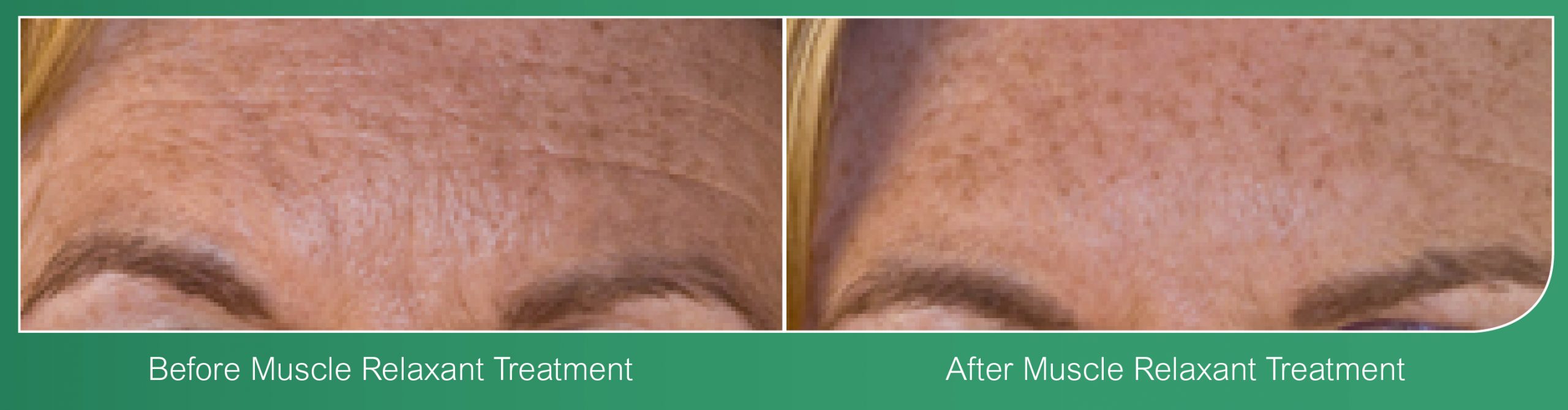 Wrinkle Reduction Coventry